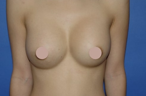 Case--4676 | After Breast Augmentation