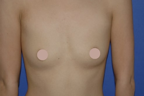 Case--4676 | Before Breast Augmentation