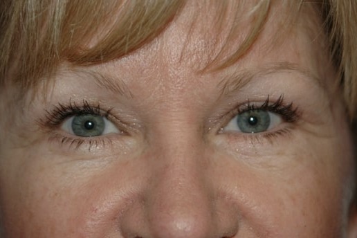 Case--8172 | After Blepharoplasty