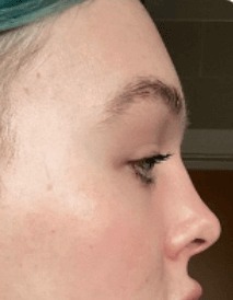 Case--2910 | After Forehead (Brow Bone) Reduction