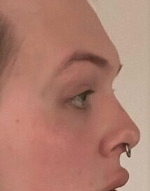 Case--2910 | Before Forehead (Brow Bone) Reduction