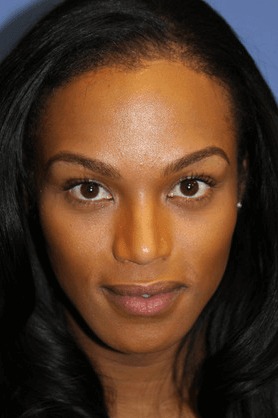 Case--4902 | After Brow Lift