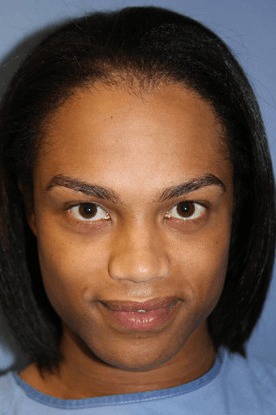 Case--4902 | Before Brow Lift