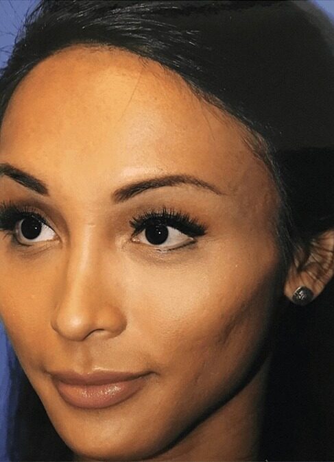 Case--3828 | After Cheek Augmentation