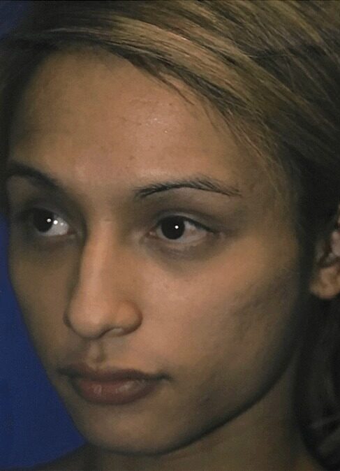 Case--3828 | Before Cheek Augmentation