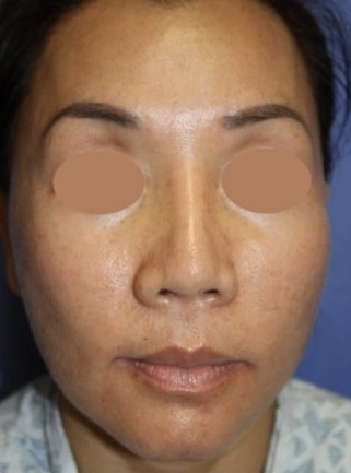 Case--2816 | After Cheek Reduction