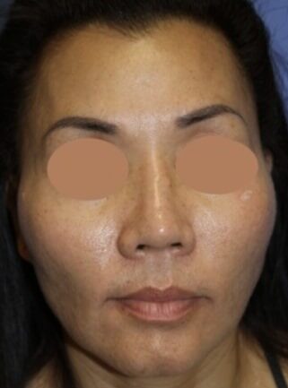 Case--2816 | Before Cheek Reduction