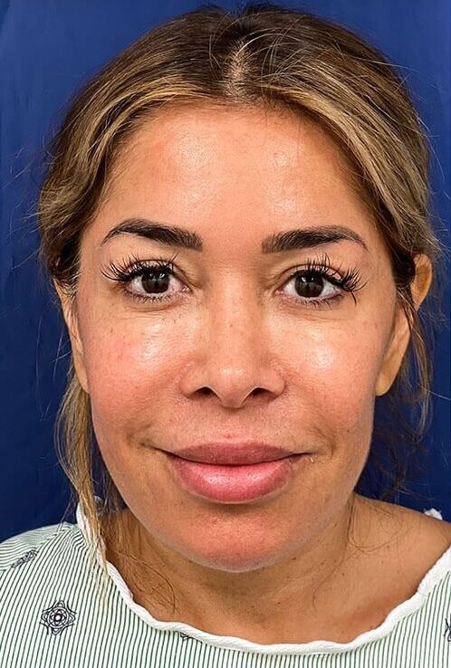 Case--4023 | Before Facelift