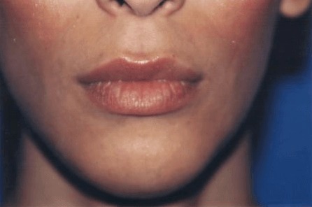 Case--9738 | After Chin Reduction