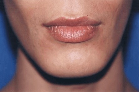 Case--9738 | Before Chin Reduction