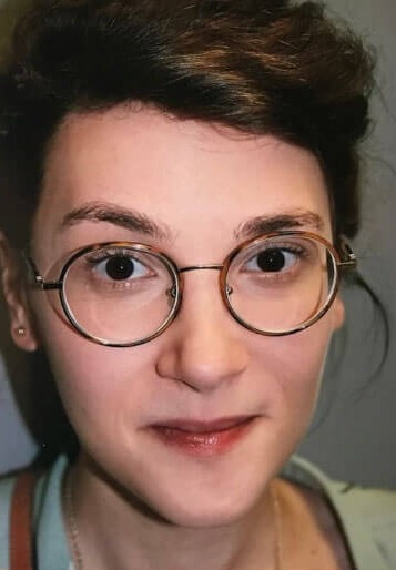 Case--2522 | After Hairline Advancement