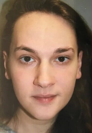 Case--2522 | Before Hairline Advancement