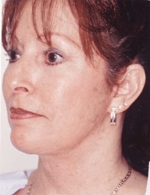 Case--9380 | After Neck Lift