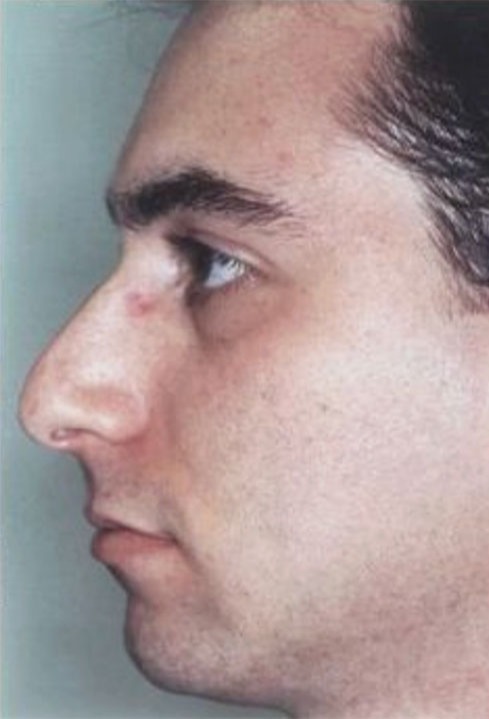 Case--3146 | Before Rhinoplasty