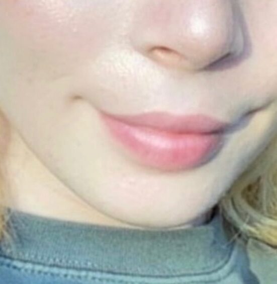 Case--4435 | After Lip Augmentation