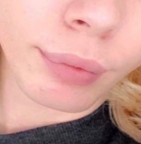 Case--4435 | Before Lip Augmentation