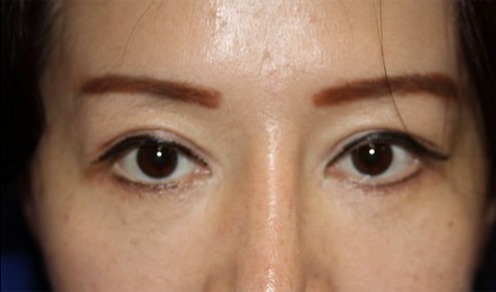 Case--8478 | After Blepharoplasty