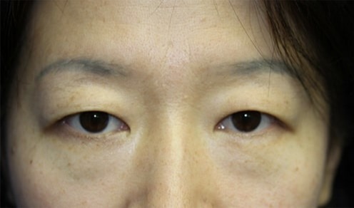 Case--8478 | Before Blepharoplasty
