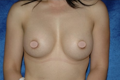 Case--1469 | After Breast Augmentation