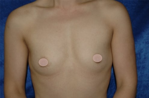 Case--1469 | Before Breast Augmentation