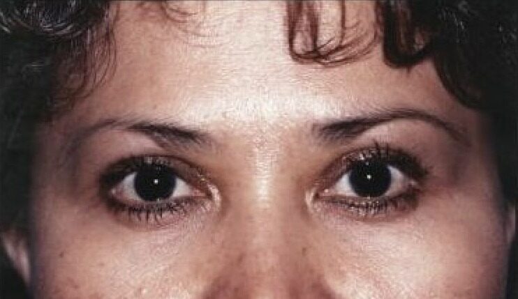 Case--3404 | After Blepharoplasty