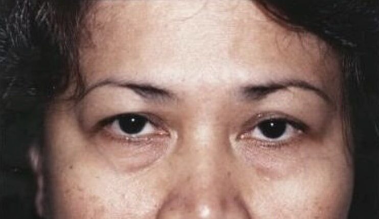 Case--3404 | Before Blepharoplasty