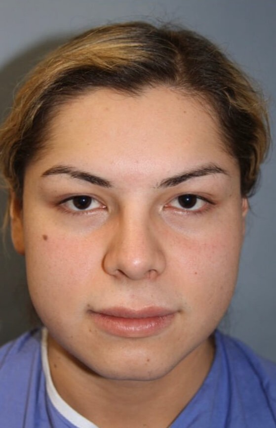Case--1577 | Before Facial Feminization Surgery
