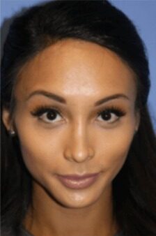 Case--3062 | After Brow Lift