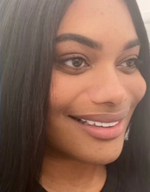 Case--5245 | After Cheek Augmentation