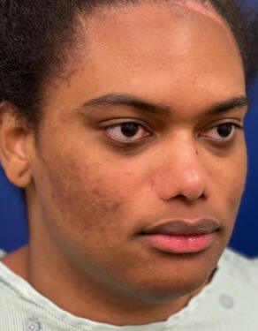 Case--5245 | Before Cheek Augmentation