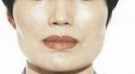 Case--7129 | Before Cheek Reduction