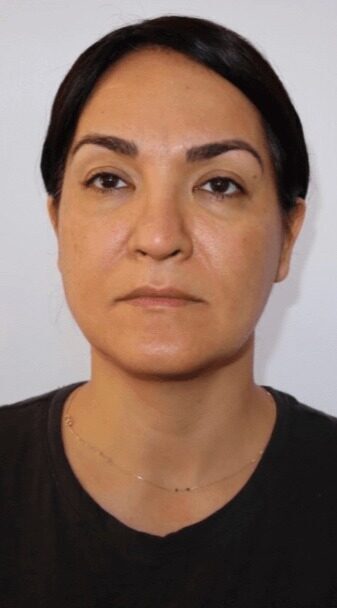 Case--8385 | Before Facelift