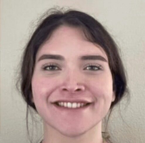 Case--6386 | After Chin Reduction