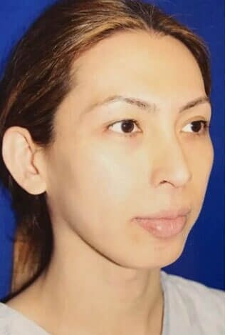 Case--8845 | Before Brow Lift