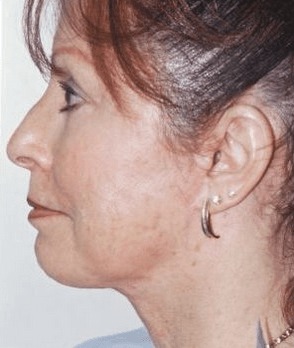 Case--9061 | After Neck Lift