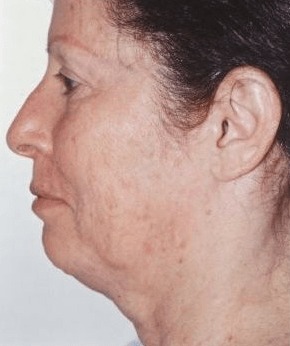 Case--9061 | Before Neck Lift