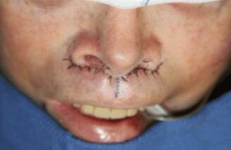 Case--8565 | After Lip Augmentation