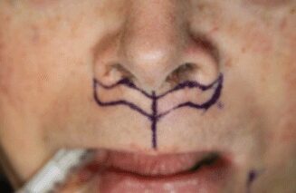 Case--8565 | Before Lip Augmentation