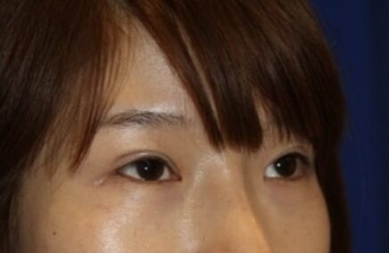 Case--1233 | After Blepharoplasty