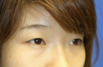 Case--1233 | Before Blepharoplasty