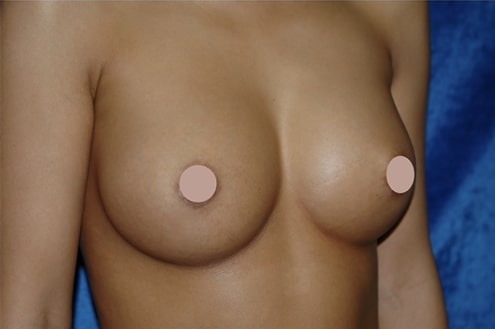 Case--1871 | After Breast Augmentation