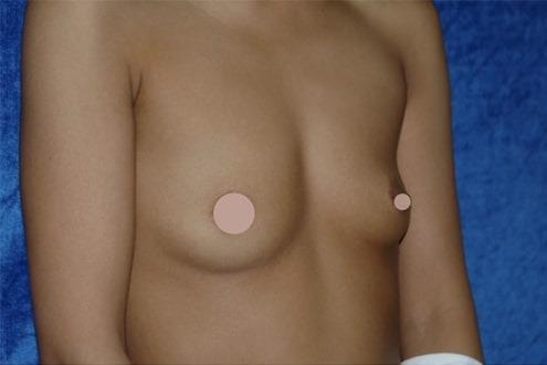 Case--1871 | Before Breast Augmentation