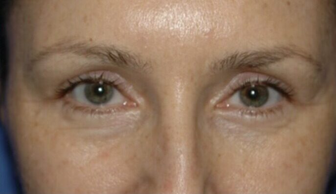 Case--8892 | After Blepharoplasty