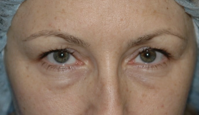 Case--8892 | Before Blepharoplasty