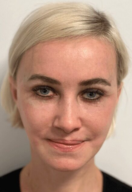 Case--5541 | After Facelift