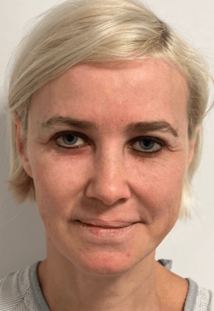 Case--5541 | Before Facelift