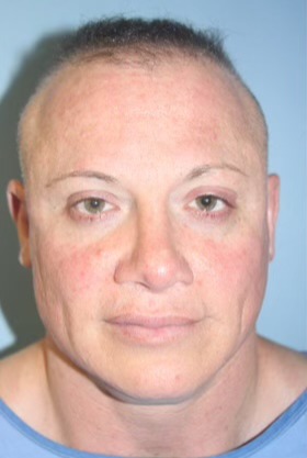 Case--5717 | Before Facial Feminization Surgery