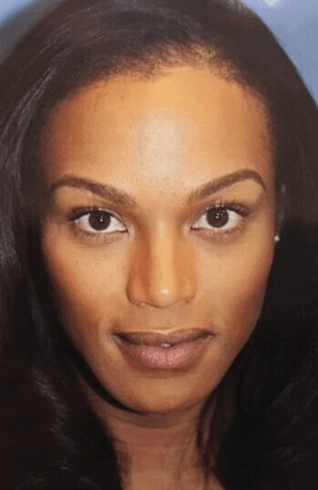 Case--8700 | After Facial Feminization Surgery