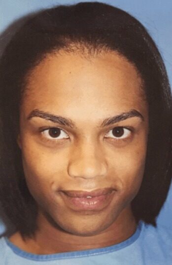 Case--8700 | Before Facial Feminization Surgery