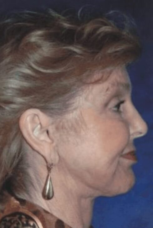 Case--3226 | After Neck Lift